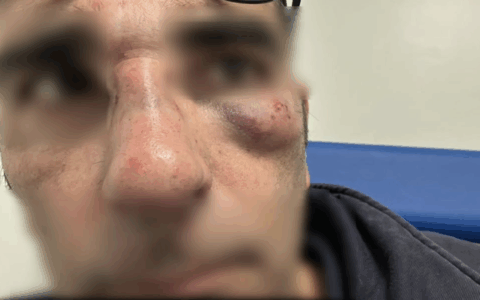 “Mi hanno colpito al volto senza motivo”, la testimonianza del controllore Cotral aggredito